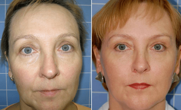 Antes e depois do procedimento de rejuvenescimento
