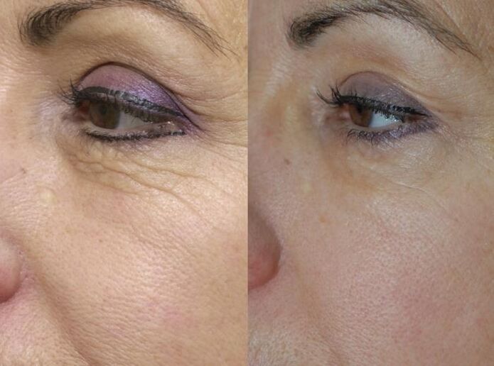 rejuvenescimento