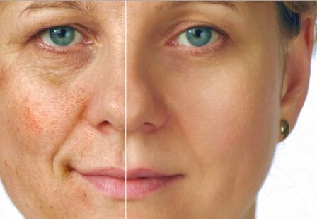 O resultado do rejuvenescimento