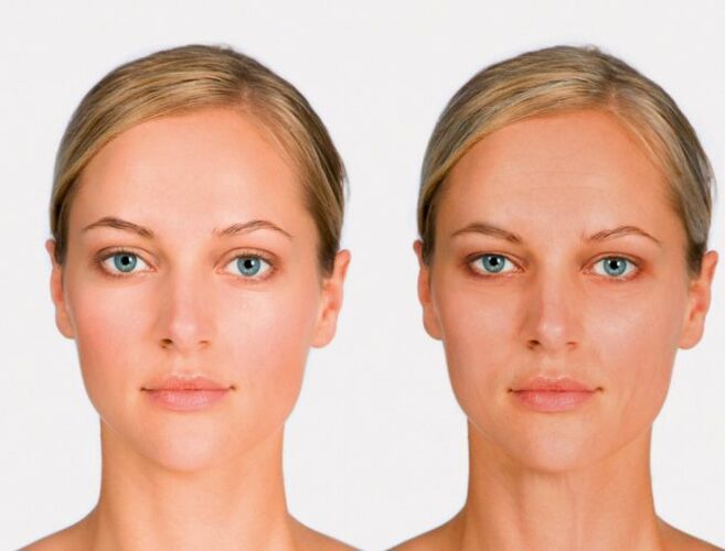 rosto depois e antes do rejuvenescimento