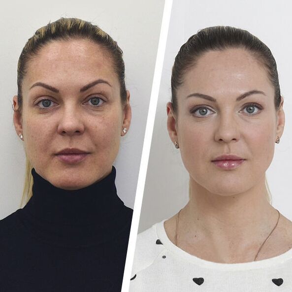 Antes e depois do rejuvenescimento da pele facial sem cirurgia