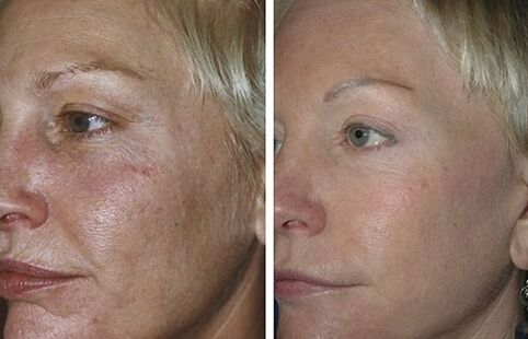 rejuvenescimento a laser fracionado antes e depois das fotos
