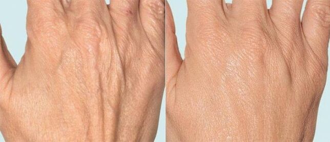 Pele das mãos antes e depois da terapia fracionada
