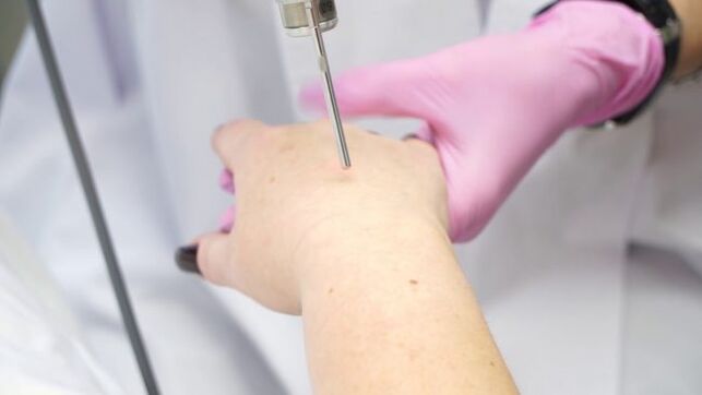 Rejuvenescimento da pele das mãos a laser