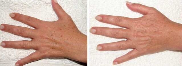 Resultado da remoção de manchas de pigmento nas mãos