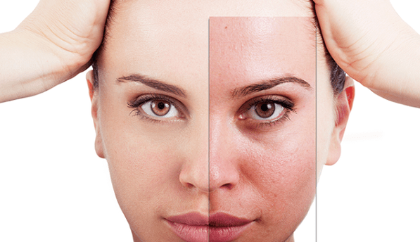o rejuvenescimento fracionado remove os principais defeitos estéticos do rosto
