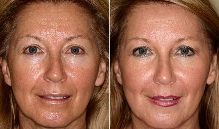 antes e depois do rejuvenescimento da pele facial em casa