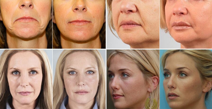 fotos de mulheres antes e depois do rejuvenescimento da pele facial