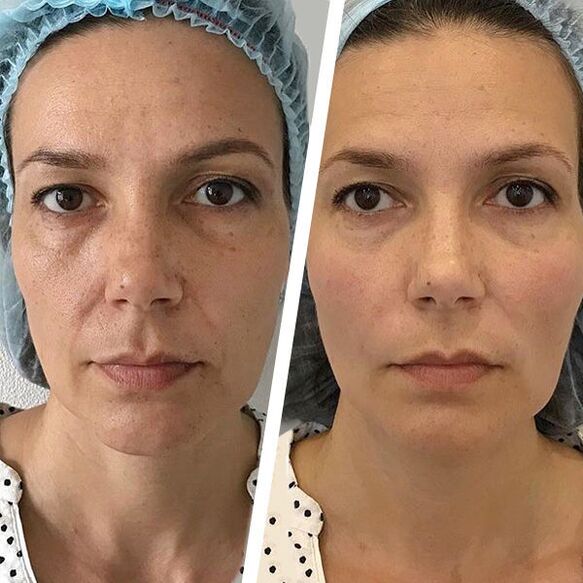 foto de rosto antes e depois do rejuvenescimento a laser