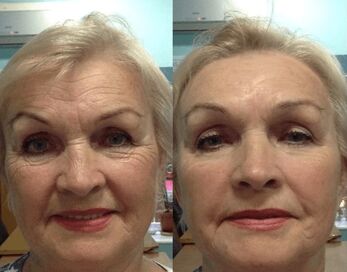 experiência de usar o creme anti-rugas Goji Cream - foto pessoal antes e depois